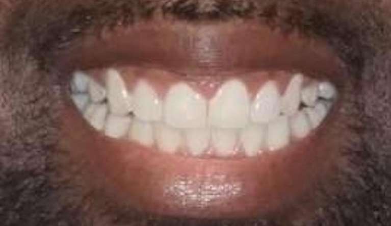 Clear-Aligners-After-Image