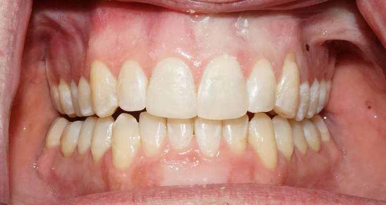 Clear-Aligners-After-Image
