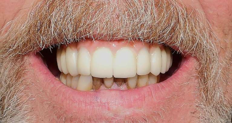 Extractions-implants-full-arch-implant-retained-hybrid-After-Image