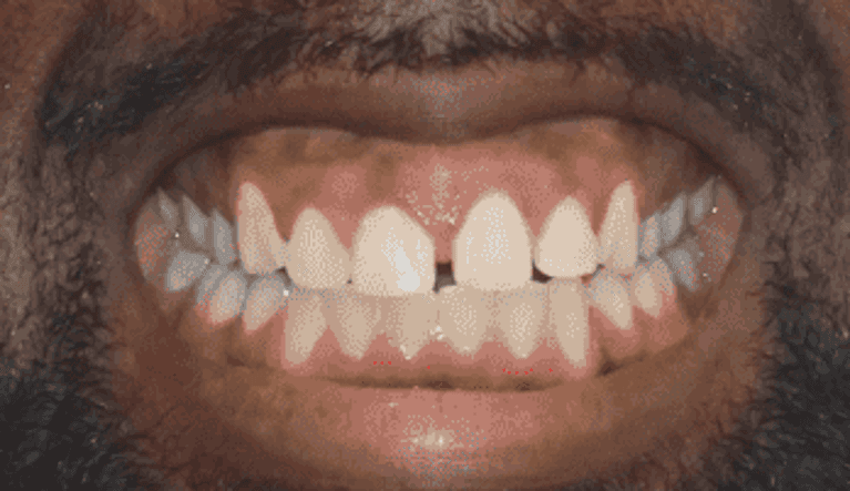 Clear-Aligners-Before-Image