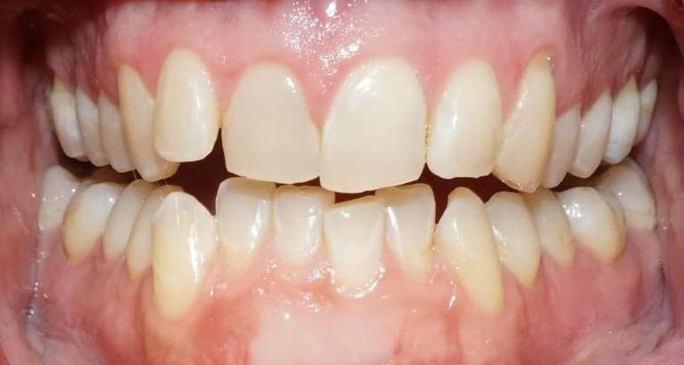 Clear-Aligners-Before-Image
