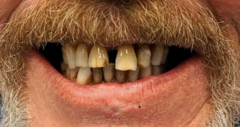 Extractions-implants-full-arch-implant-retained-hybrid-Before-Image